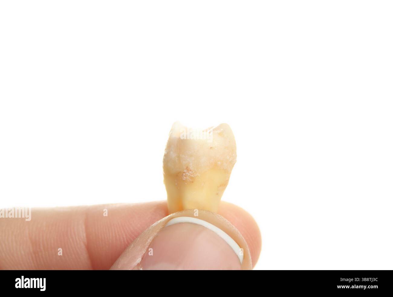 Hand holding wisdom tooth after extraction. Real wisdom tooth or third ...