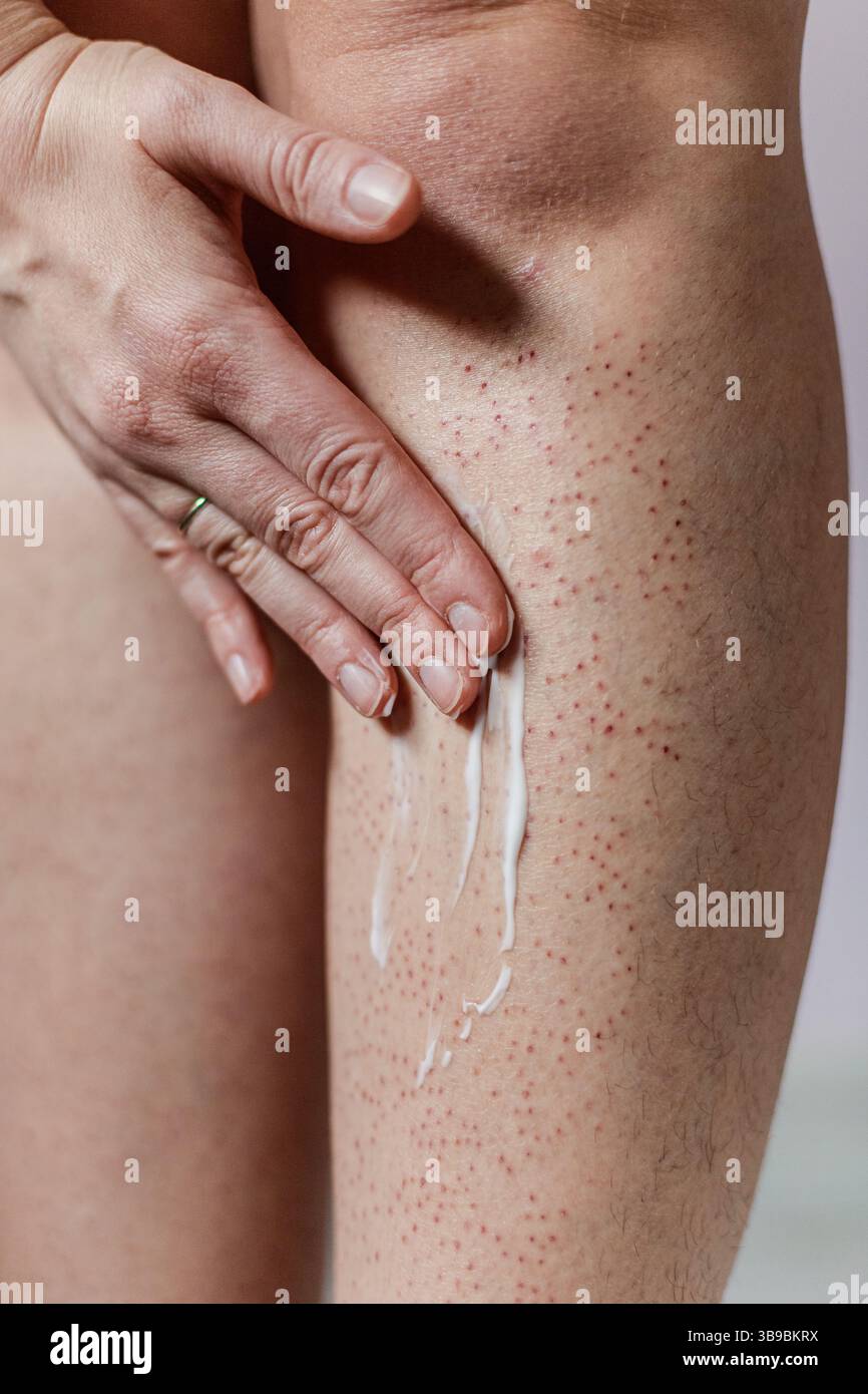 Close-up of female leg with skin rash after epilation, hand applying ...
