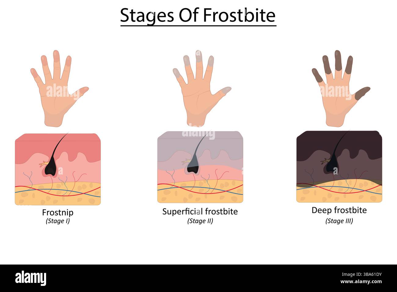 Stages of frostbite vector illustration Stock Vector