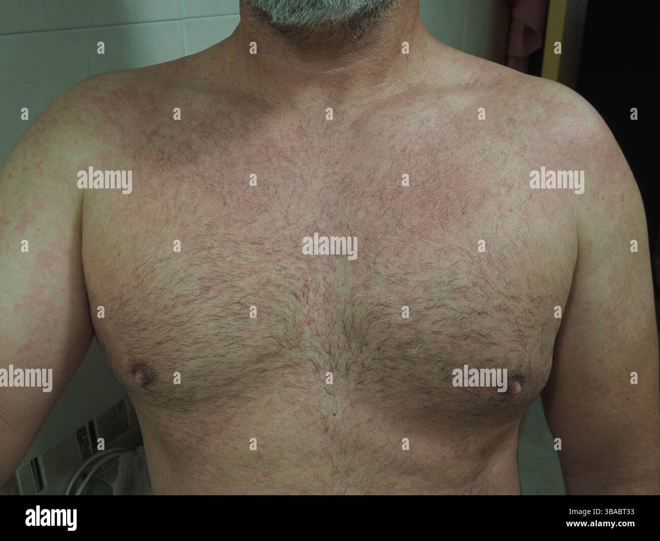 Chest Rashes In Men Skin rash urticaria allergic skin hi-res stock photography and images ...