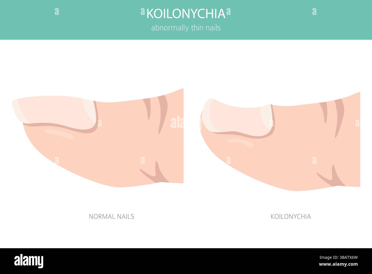 Koilonychia Or Spoon Nails Is A Nail Condition Where Nails Become koilonychia-or-spoon-nails-is-a-nail-condition-where-nails-become