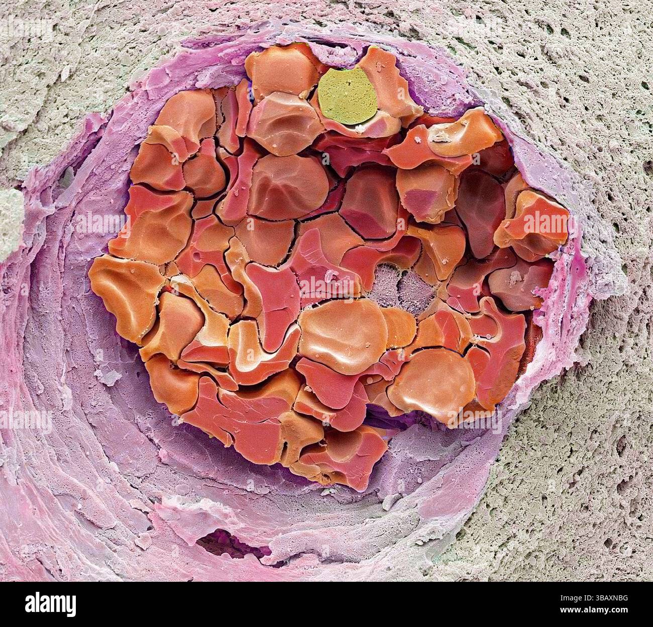 Blood vessel blockage. Coloured scanning electron micrograph (SEM) of a ...