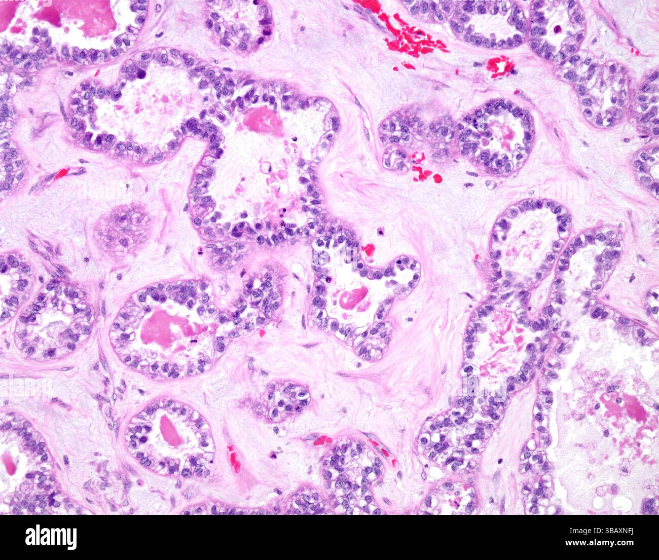 Clear cell carcinoma of an ovary, light micrograph. Clear cell ...