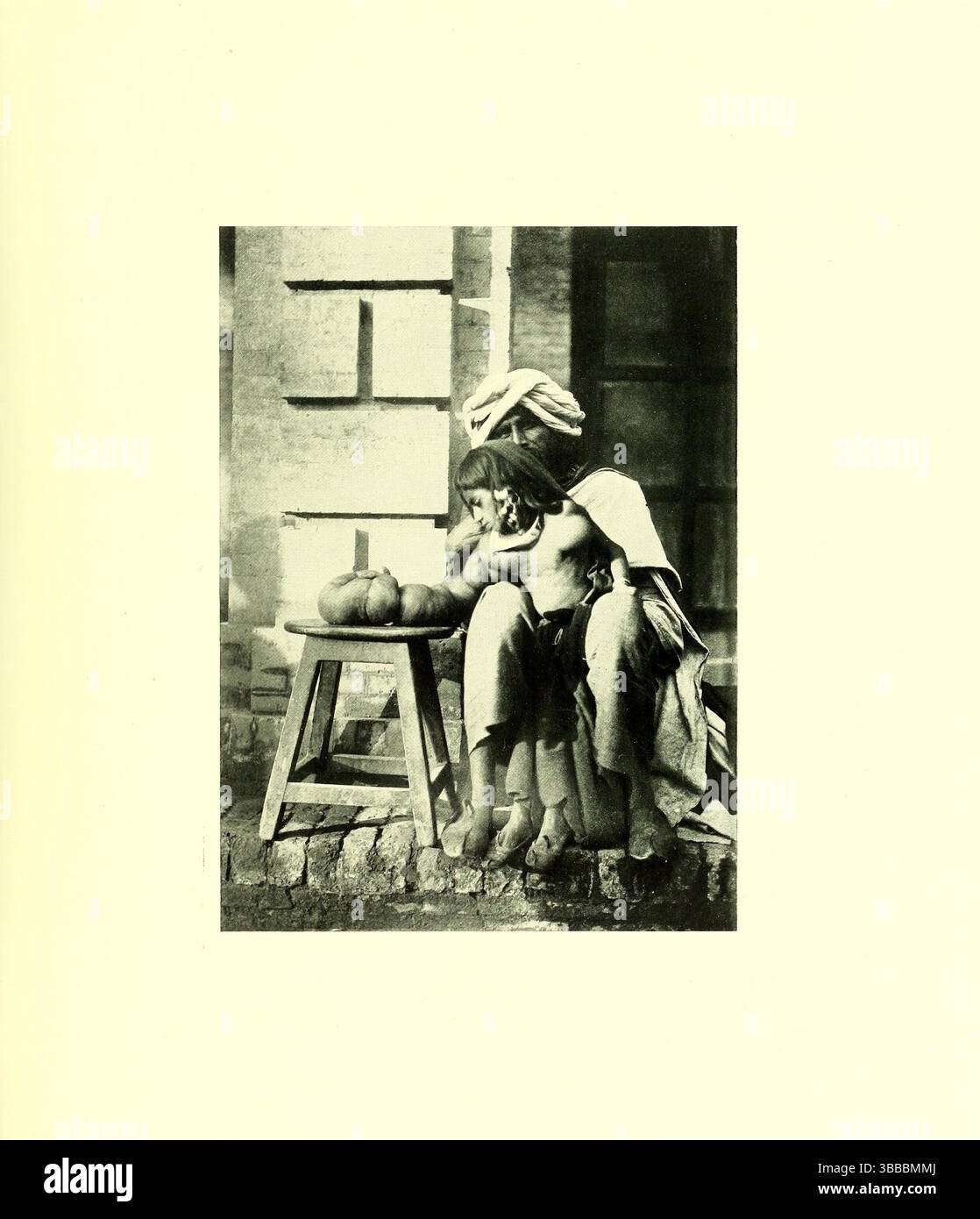 Elephantoid Hypertrophy Of Upper Extremity In A Child. Vintage Archive ...
