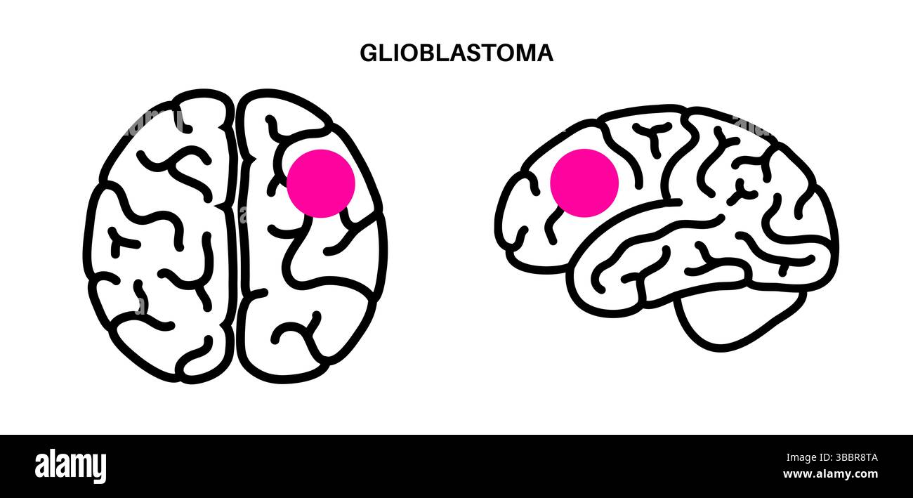 Photo inspiration: Fresh Look at Illustration Of A Glioblastoma This Is A Highly Aggressive Cancerous