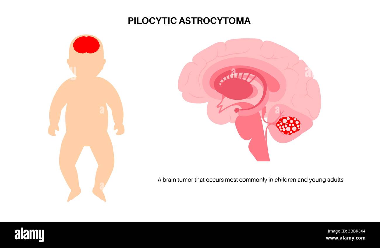 Illustration of a pilocytic astrocytoma in an infant. This is a low ...