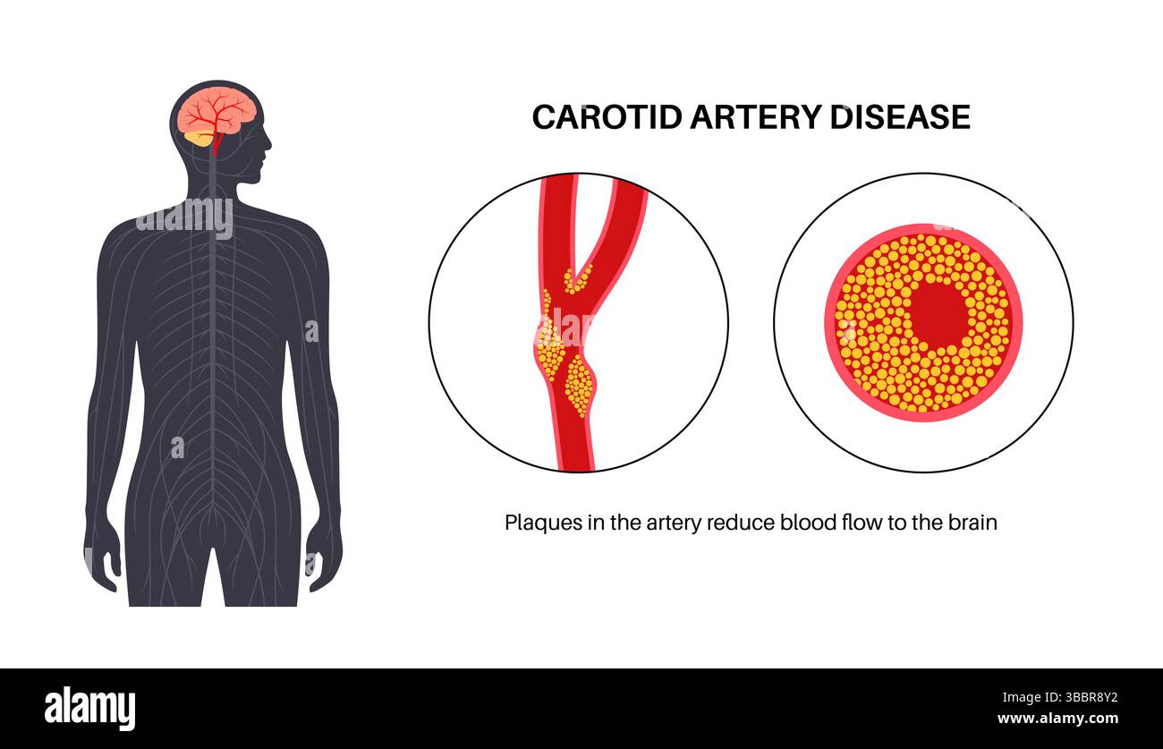 Illustration of carotid artery disease. This occurs when fatty deposits ...