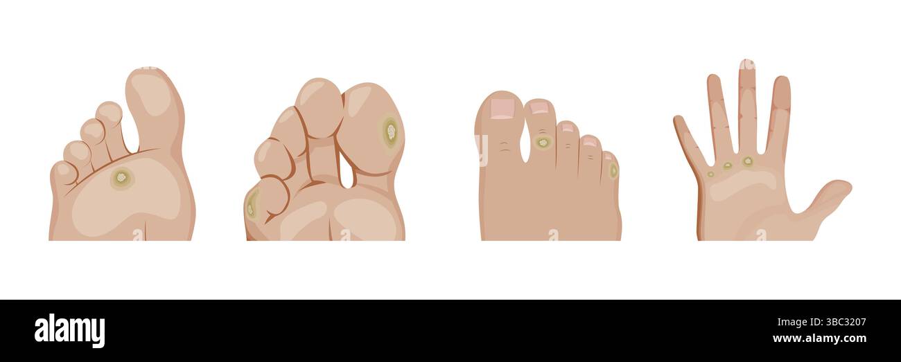 Skin Callules Displaying various locations of calluses and corns on human feet and ...