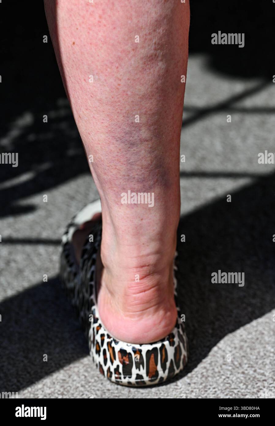 Middle aged woman with badly bruised calf muscle  and ankle on back of her leg after a fall : Stock Photo