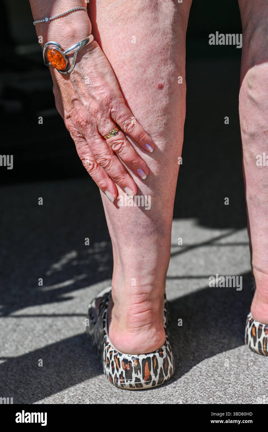 Middle aged woman with badly bruised calf muscle  and ankle on back of her leg after a fall : Stock Photo