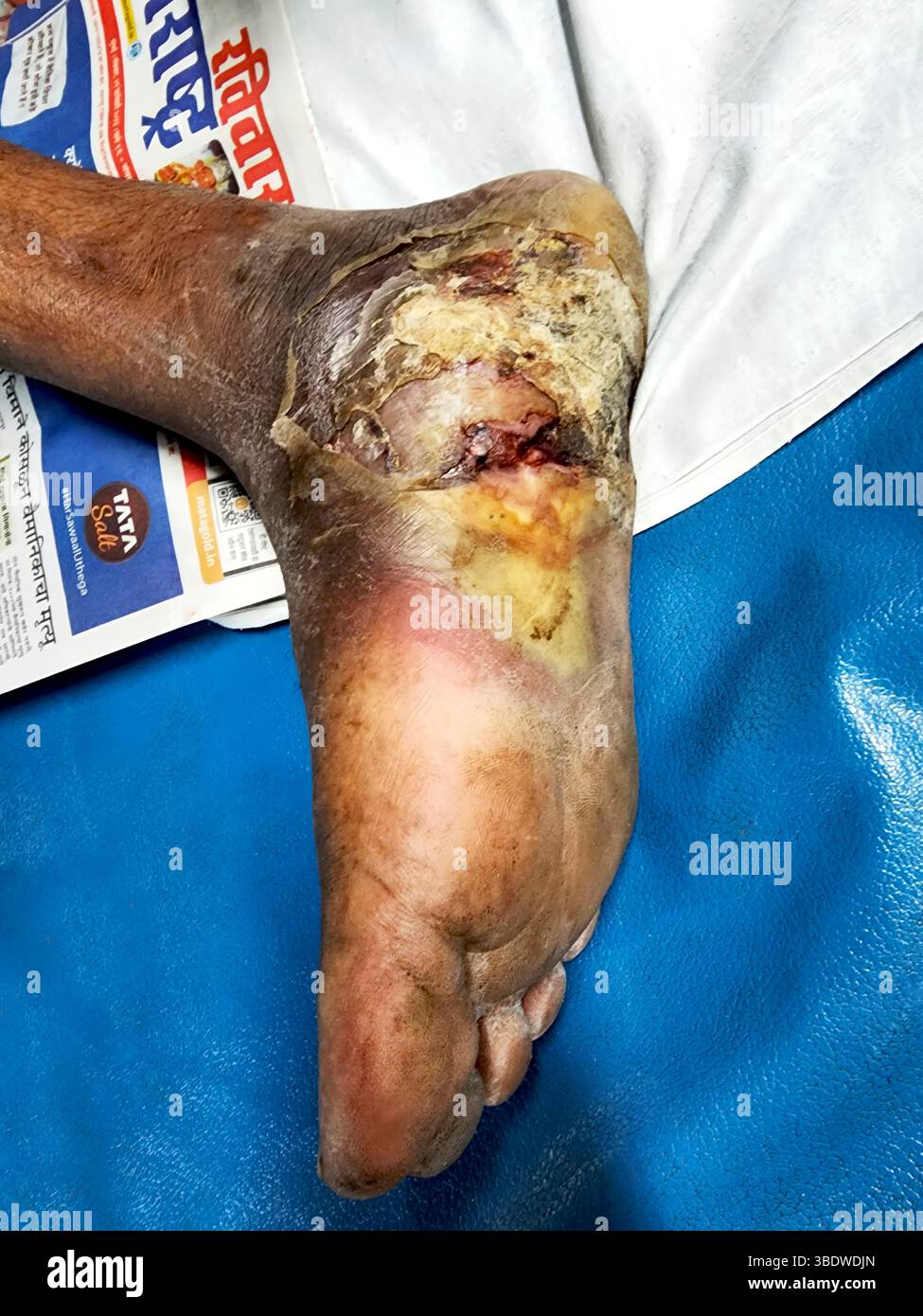 Detailed photograph illustrating a diabetic foot, a common complication resulting from diabetes. Stock Photo