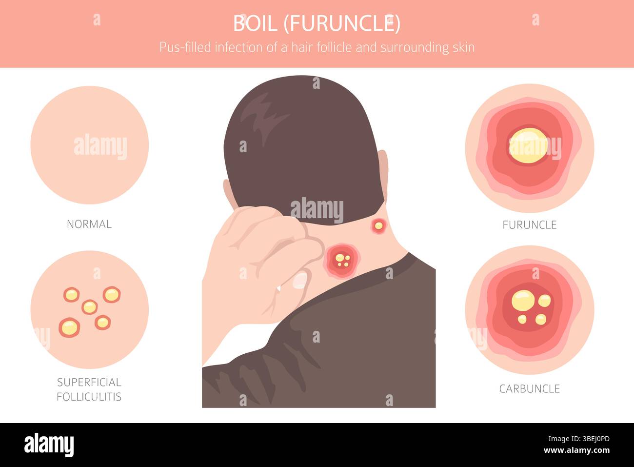 Boil, Furuncle, carbuncle. Skin diseases. Medical infographic design ...