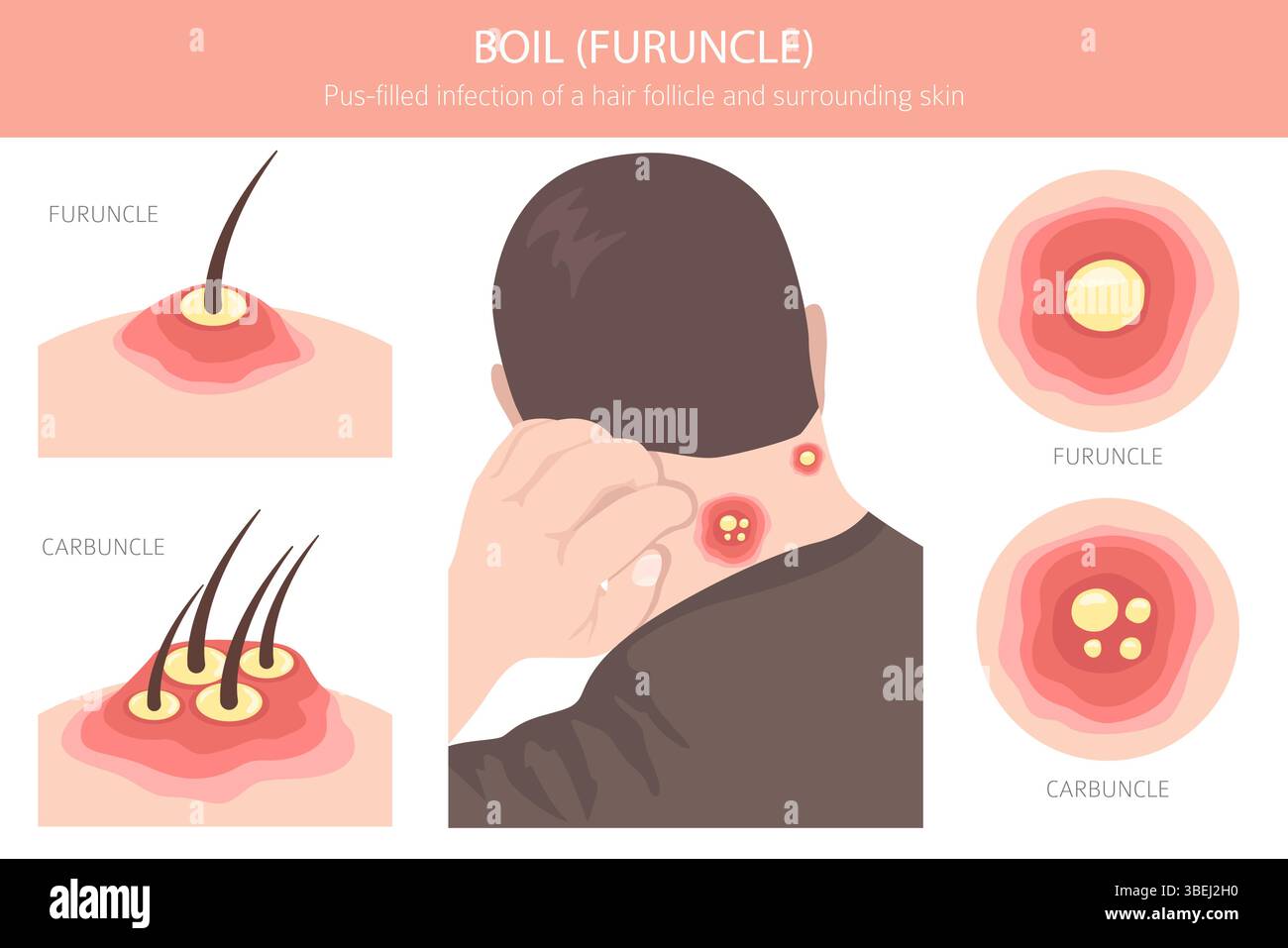 Boil, Furuncle, carbuncle. Skin diseases. Medical infographic design ...