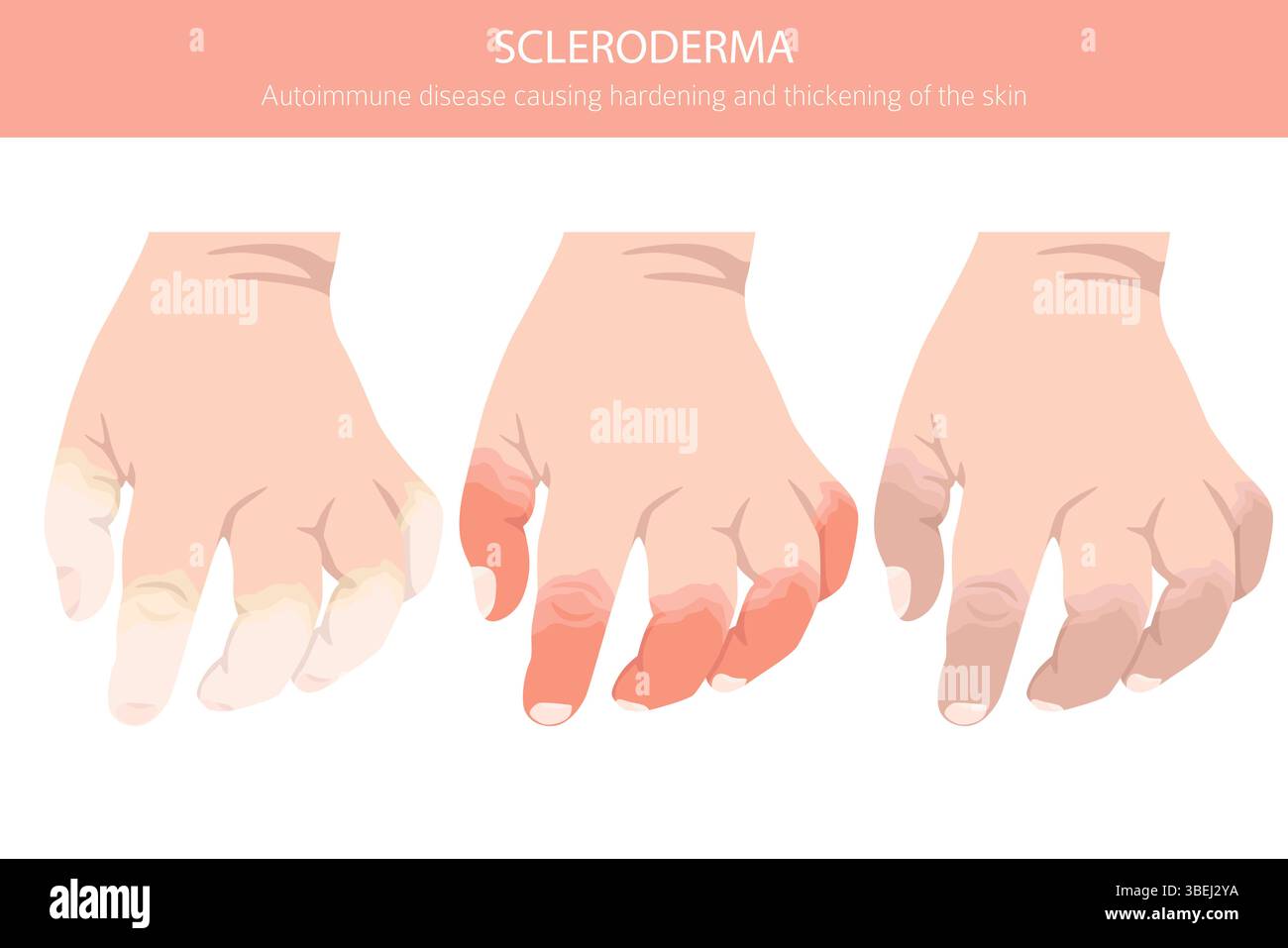 Sleroderma Rash Scleroderma. Skin diseases. Medical infographic design. Vector ...