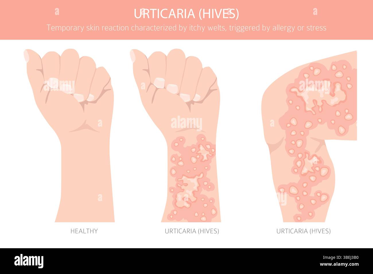 Urticaria Vector Urticaria. Hives. Skin diseases. Medical infographic design. Vector ...