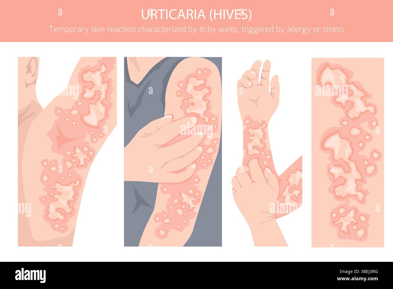Urticaria Vector Urticaria. Hives. Skin diseases. Medical infographic design. Vector ...