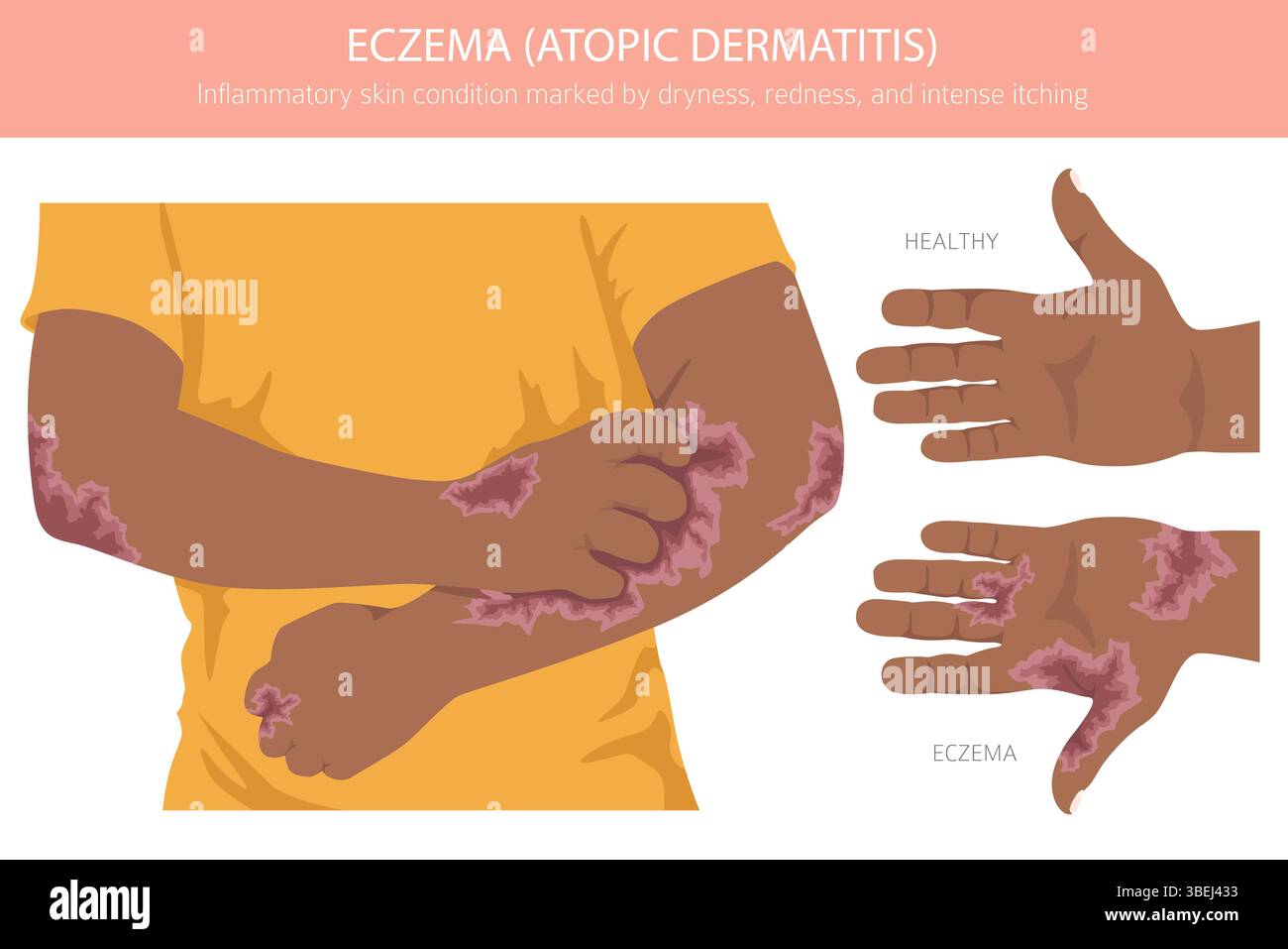Eczema. Atopic dermatitis. Skin diseases. Medical infographic design ...