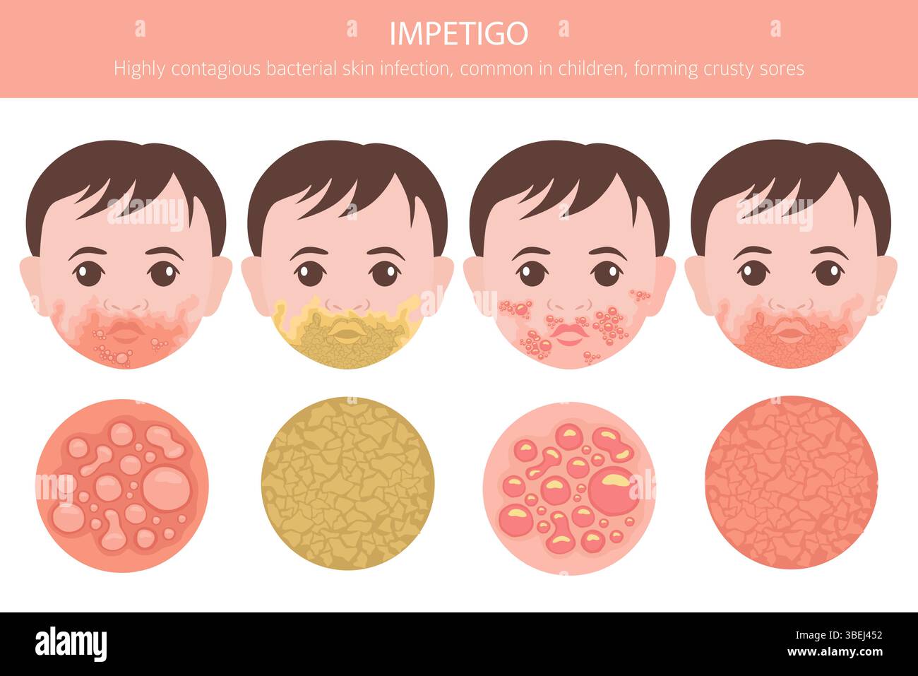 Impetigo Skin Diseases Medical Infographic Design Vector 