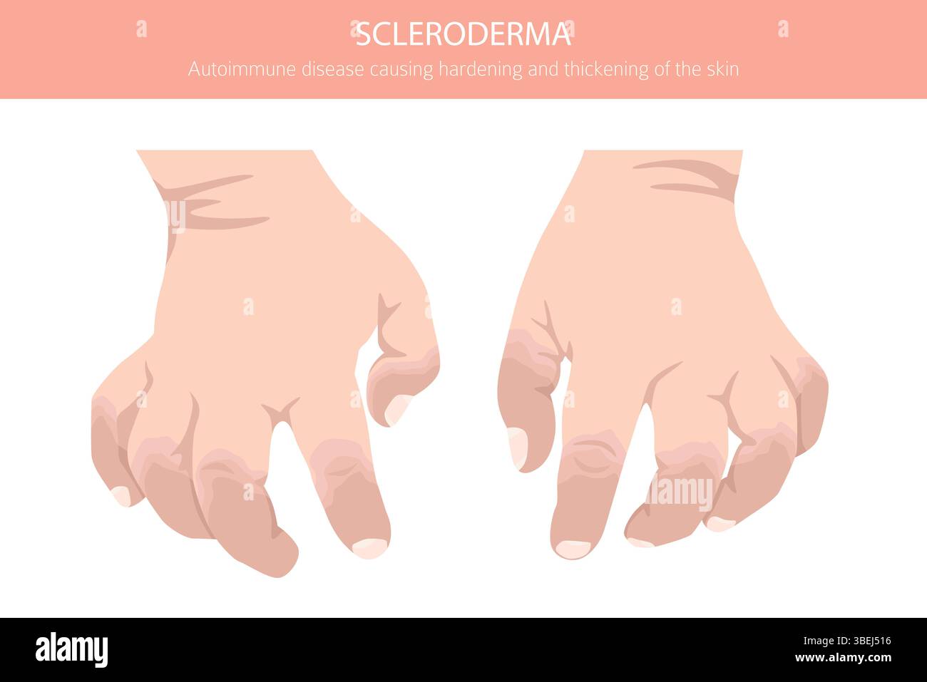 Sleroderma Rash Scleroderma. Skin diseases. Medical infographic design. Vector ...