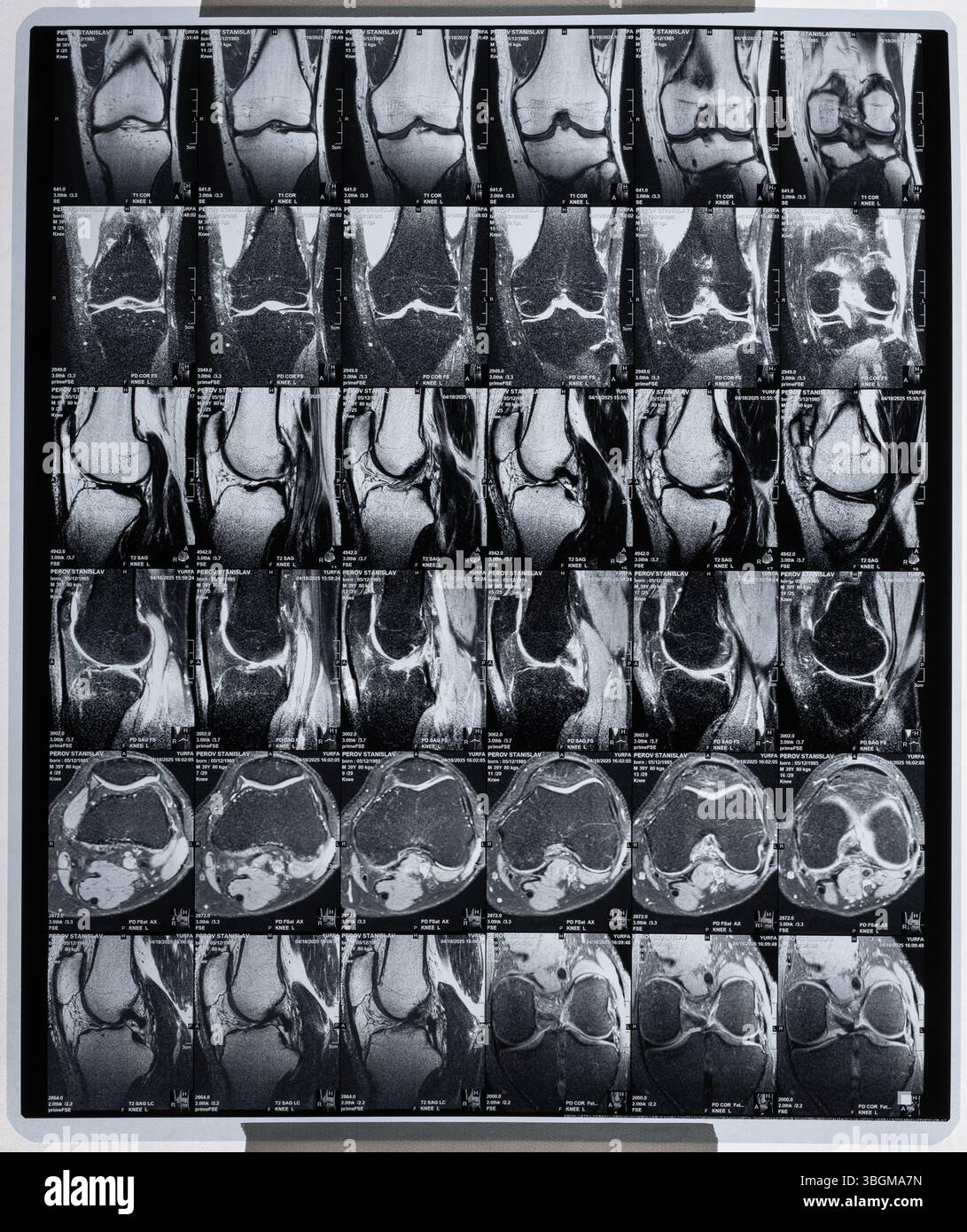 MRI of knee joint of man, print of multiple scans Stock Photo - Alamy
