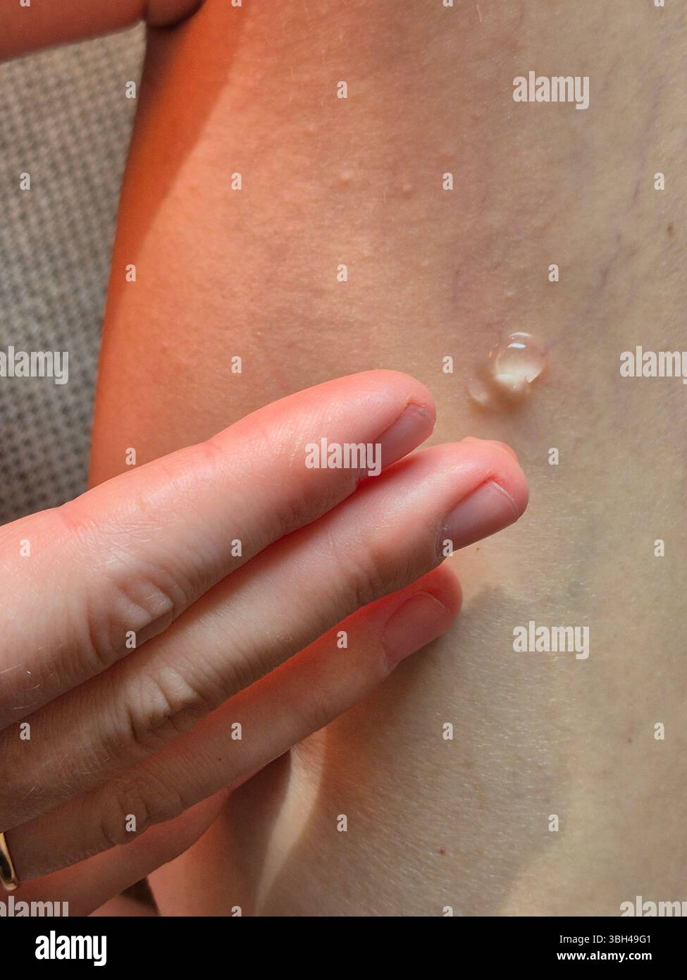 cream for spider veins on legs. woman applies cream to body. cream-gel on leg. tube of ointment in hands. problems with veins - Smartphone Captured Stock Image