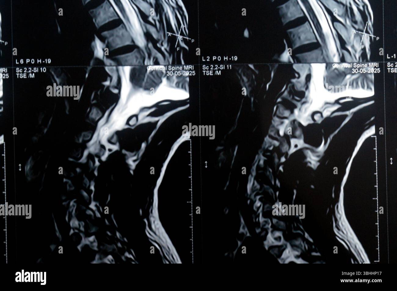 MRI of cervical spine reveals Spondylodegenerative changes along the ...