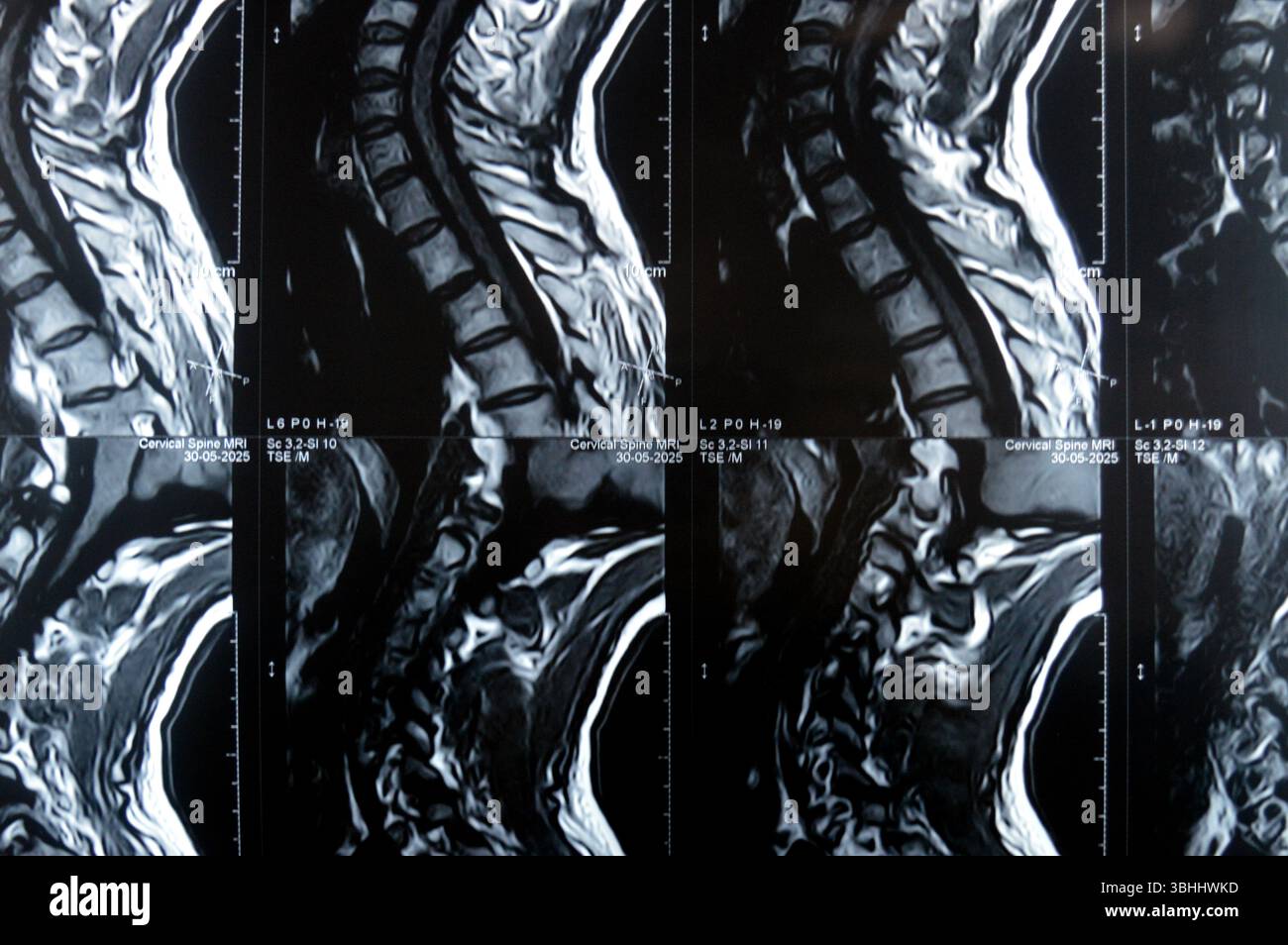 MRI of cervical spine reveals Spondylodegenerative changes along the ...