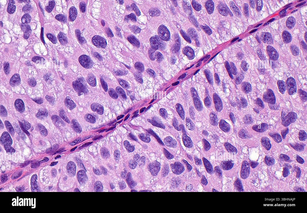 Light micrograph of papillary urothelial cancer. Urothelial carcinoma ...
