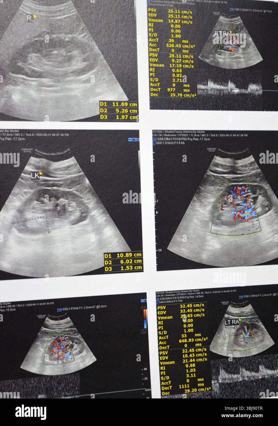 Normal Rennal Cairo, Egypt, June 12 2025: Normal renal sonographic examination with ...