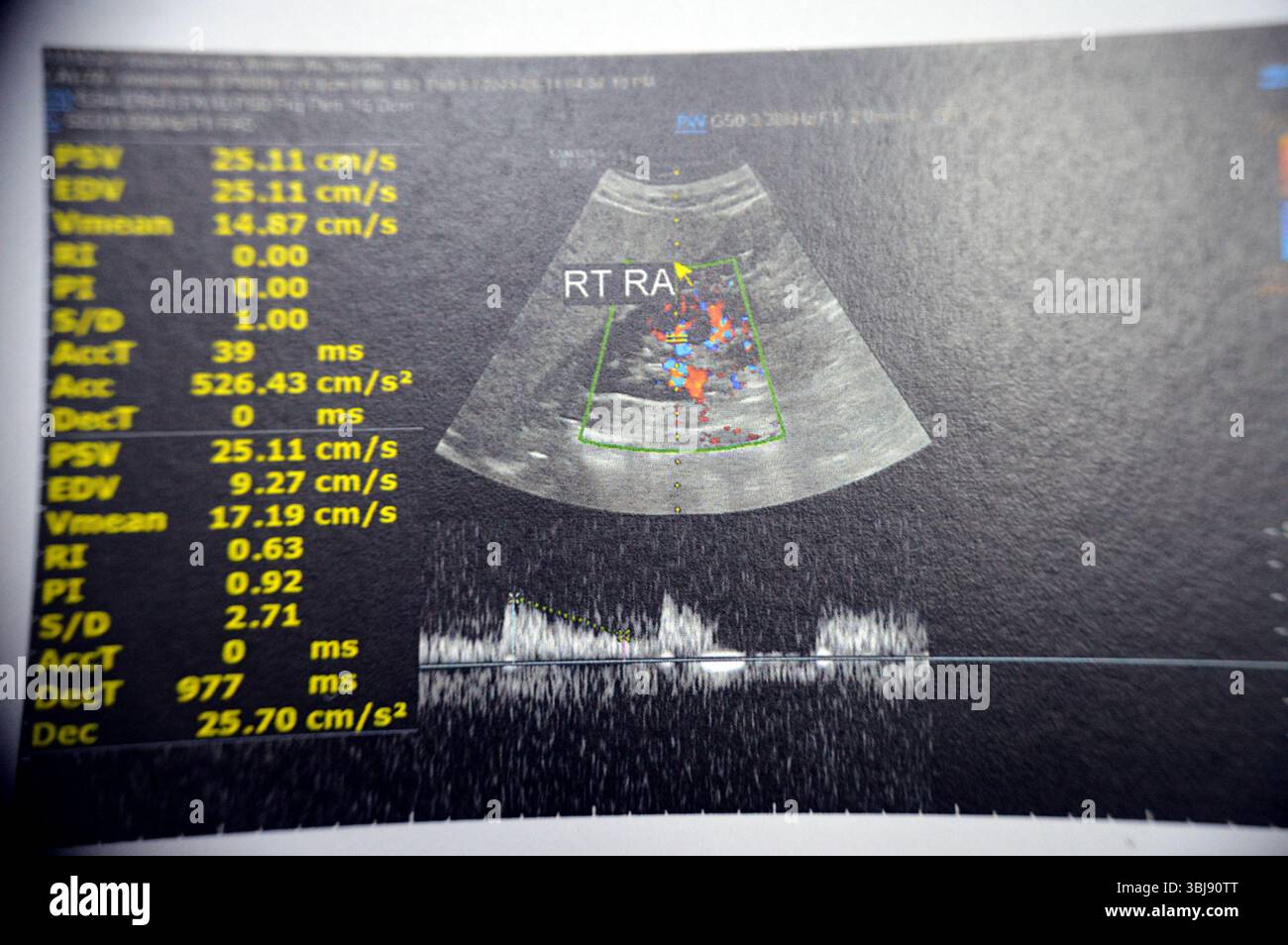 Normal Rennal Cairo, Egypt, June 12 2025: Normal renal sonographic examination with ...