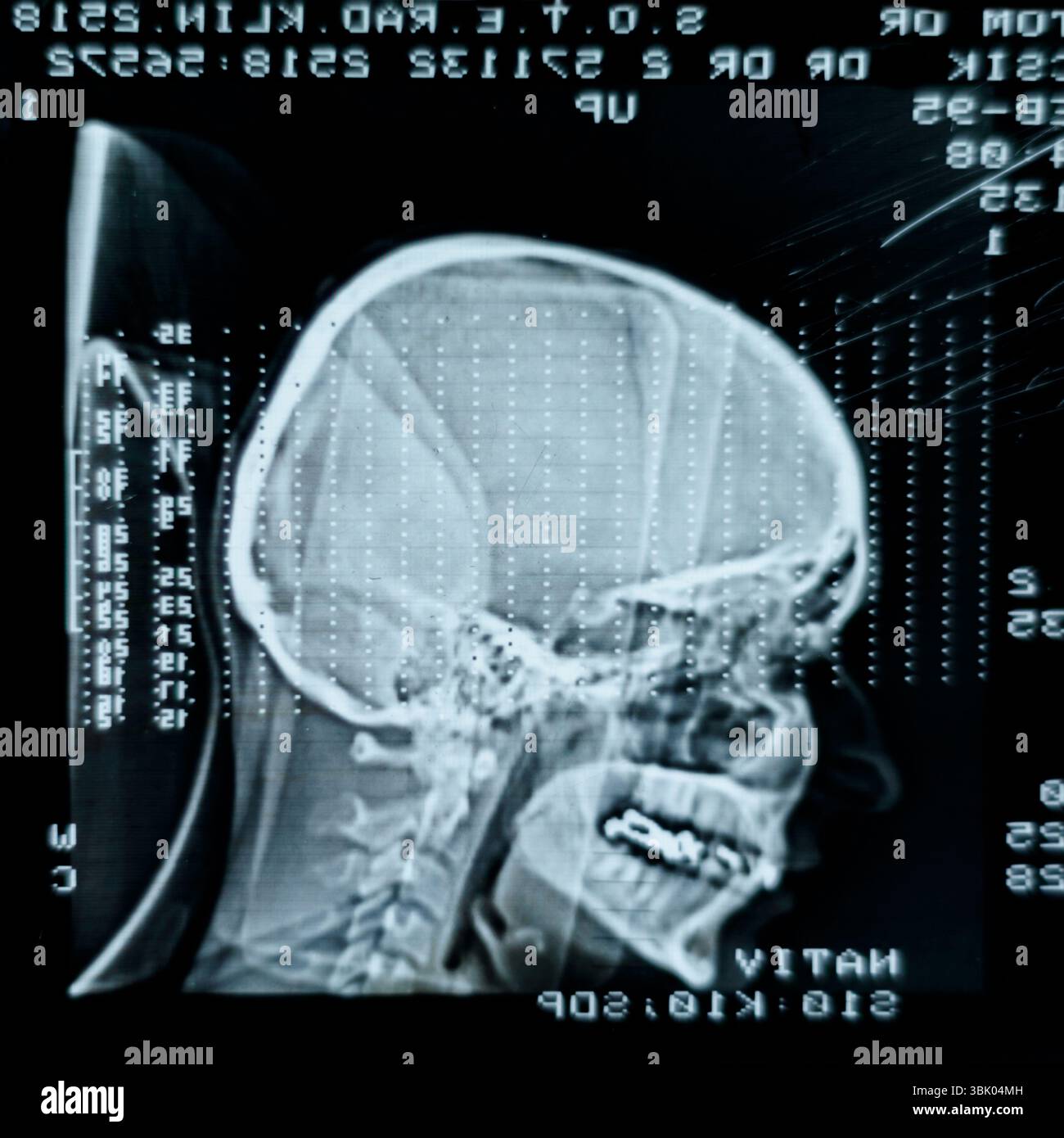 Human head mri brain scan hi-res stock photography and images - Alamy