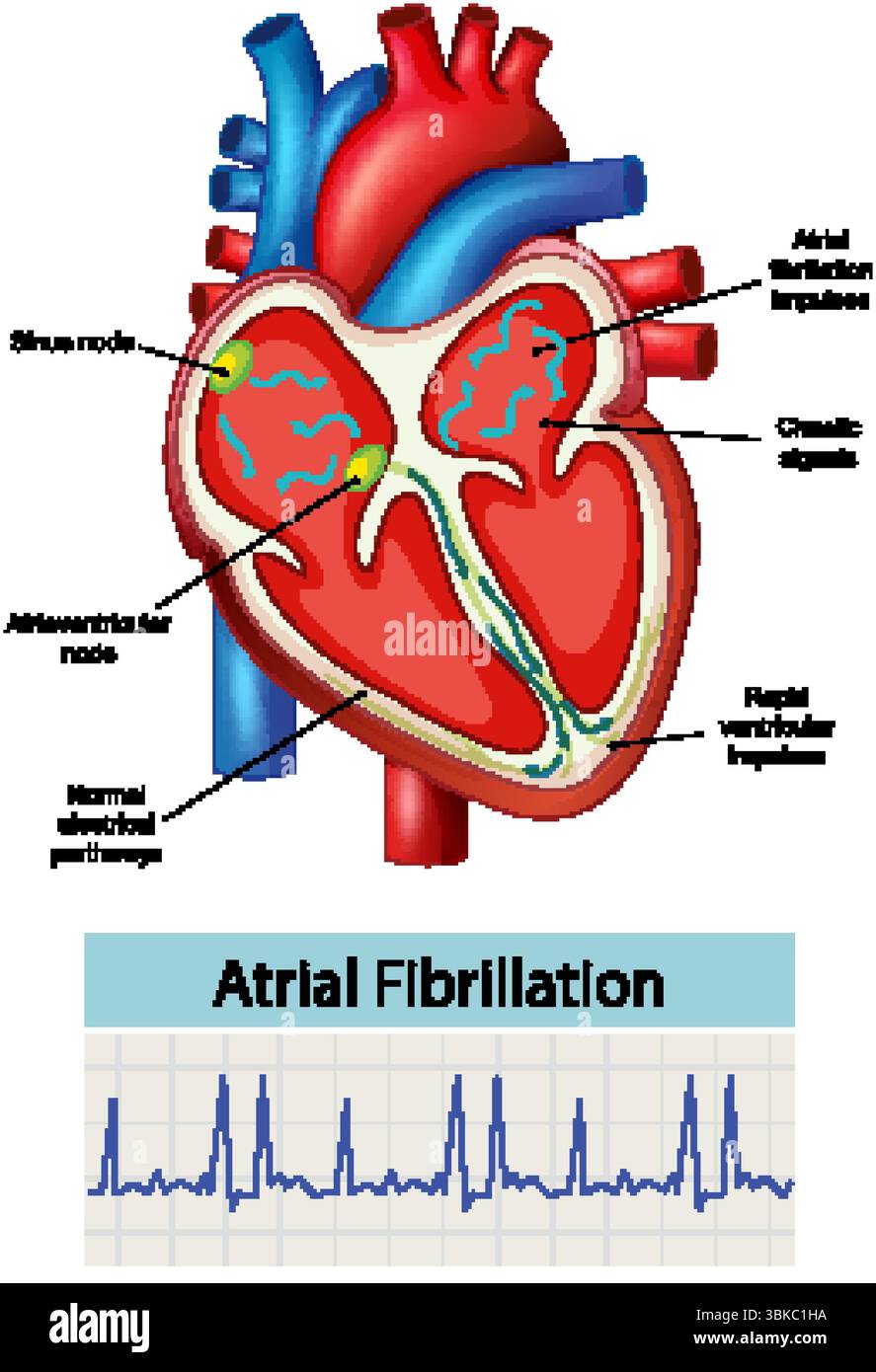 Vector illustration of heart anatomy highlighting atrial fibrillation ...