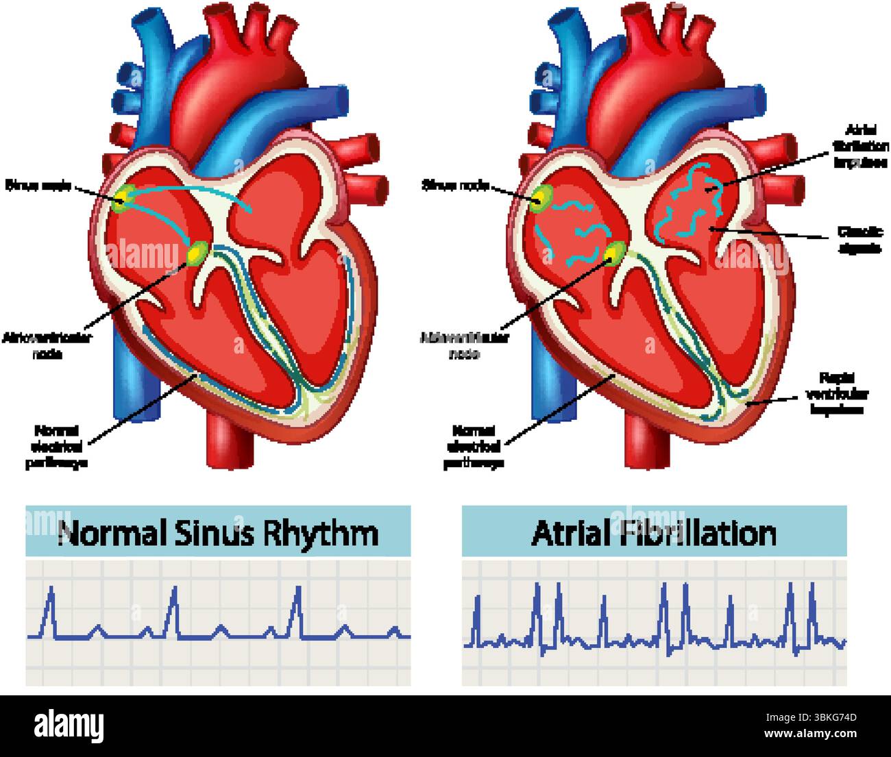 Detailed vector illustration comparing normal sinus rhythm and atrial fibrillation with labeled heart anatomy and ECG traces Stock Vector