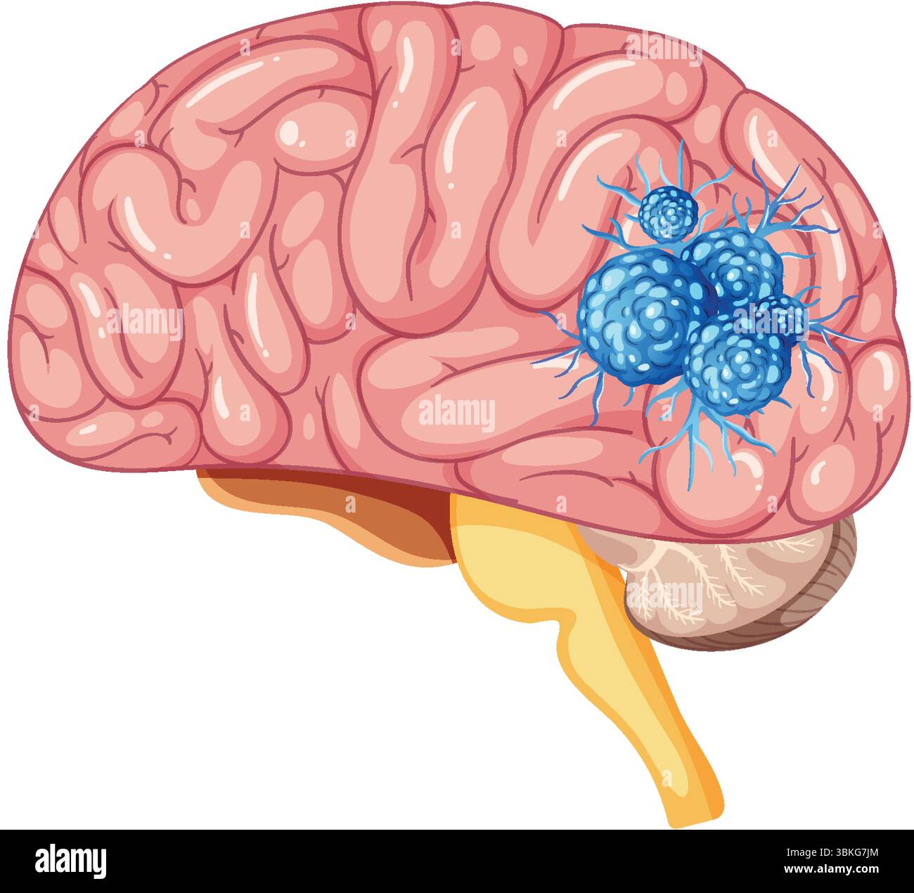 Detailed vector illustration of a human brain highlighting a tumor ...