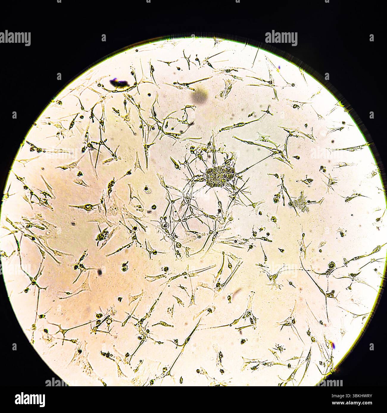 Glioblastoma cell culture. Human glioma cells under magnification Stock ...