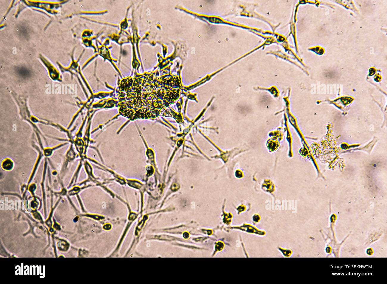 Glioblastoma cell culture. Human glioma cells under magnification Stock ...