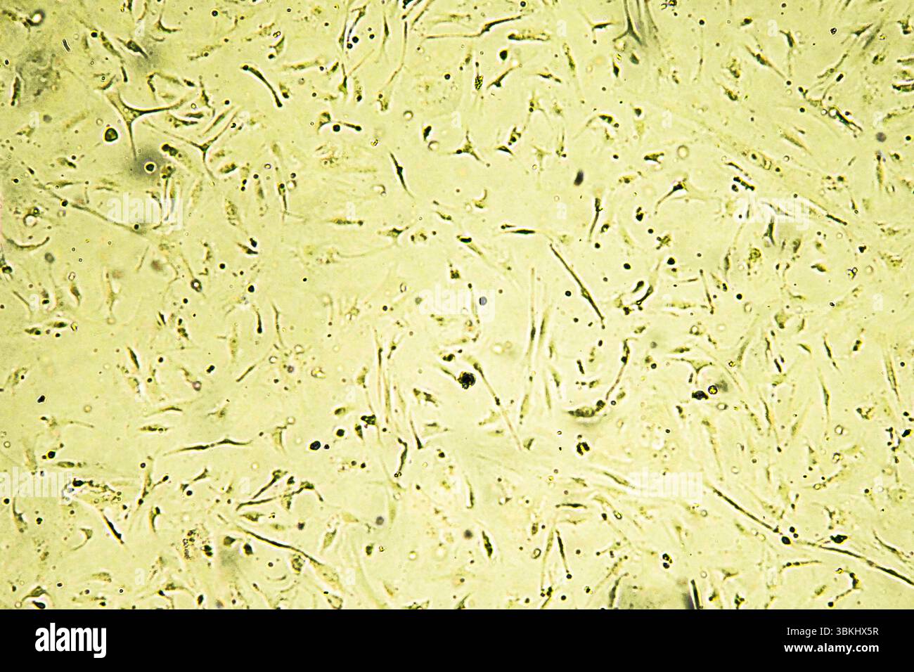 Glioblastoma cell culture. Human glioma cells under magnification Stock ...