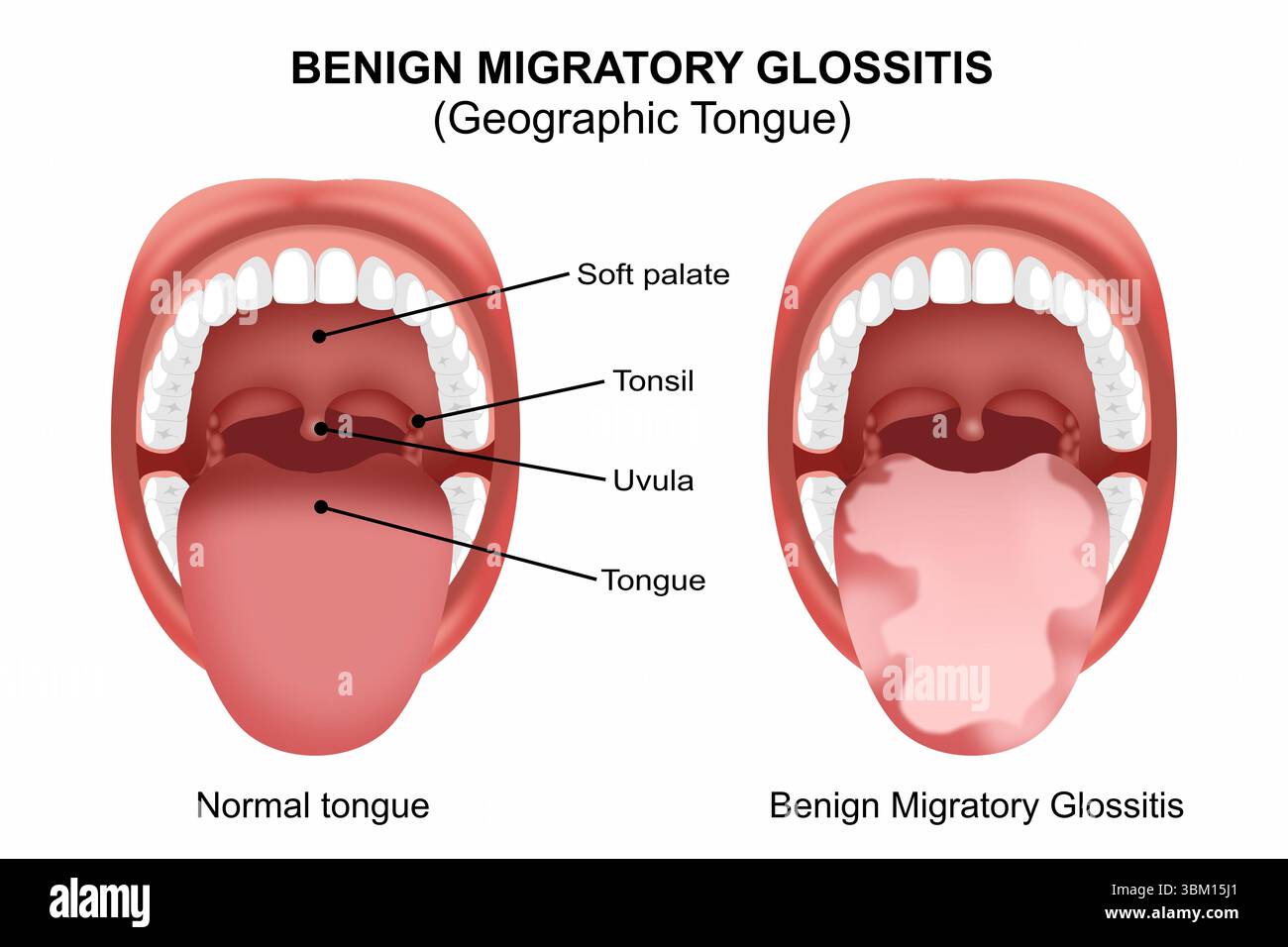 Benign Migratory Glossitis Stock Photo - Alamy