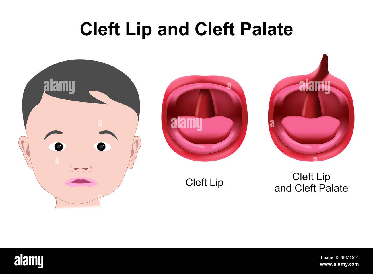 Cleft lip and cleft palate Stock Photo - Alamy