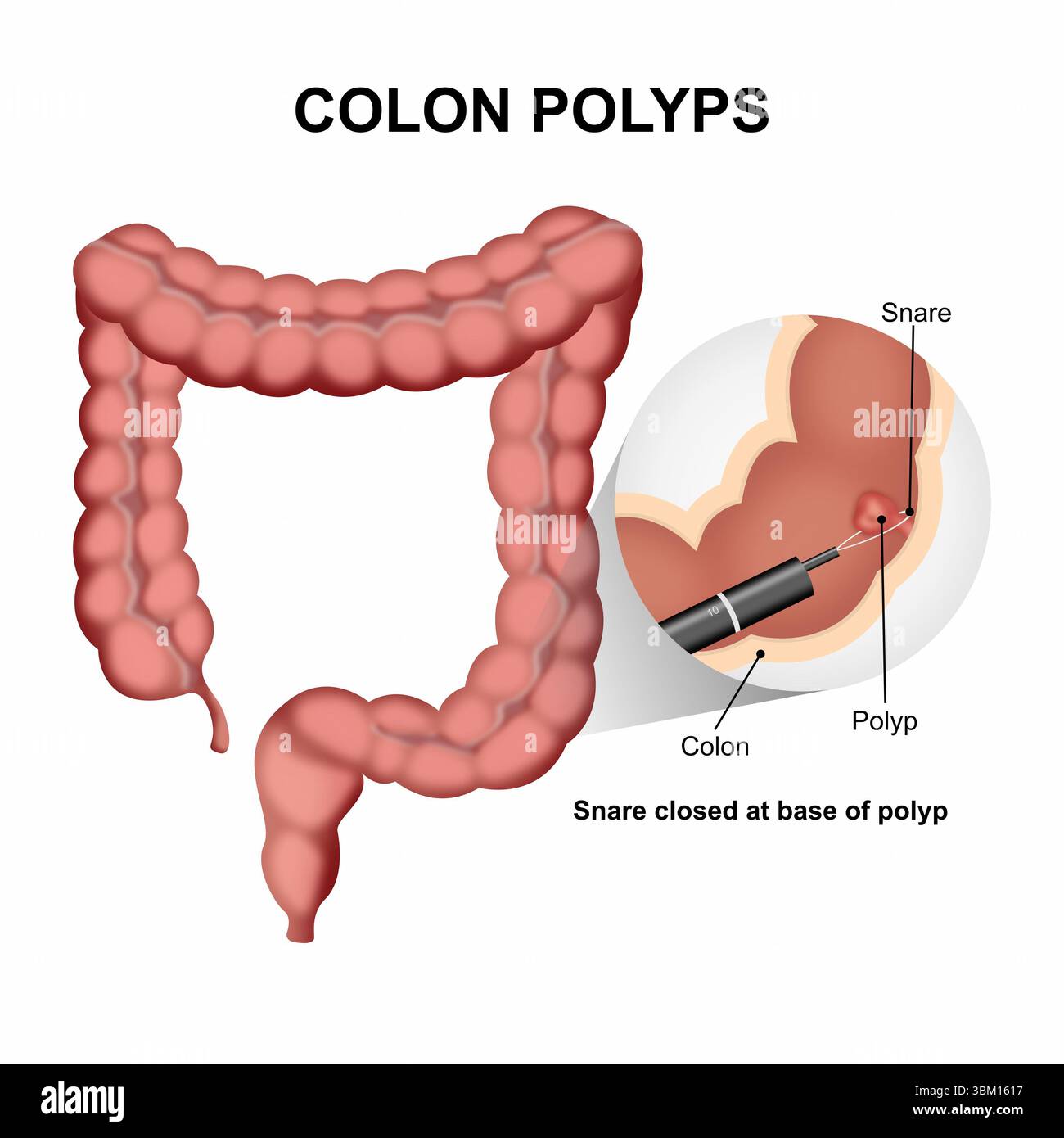 Colon polyp hi-res stock photography and images - Alamy
