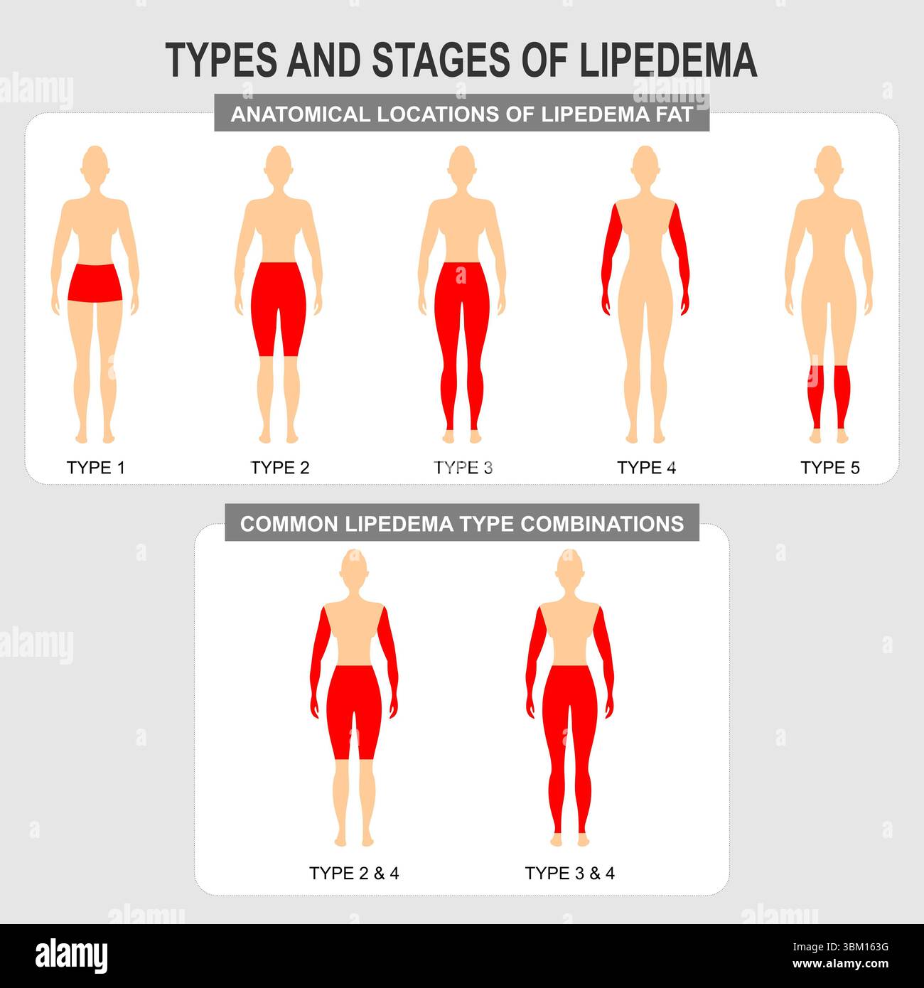 Types and stages of lipedema Stock Photo - Alamy