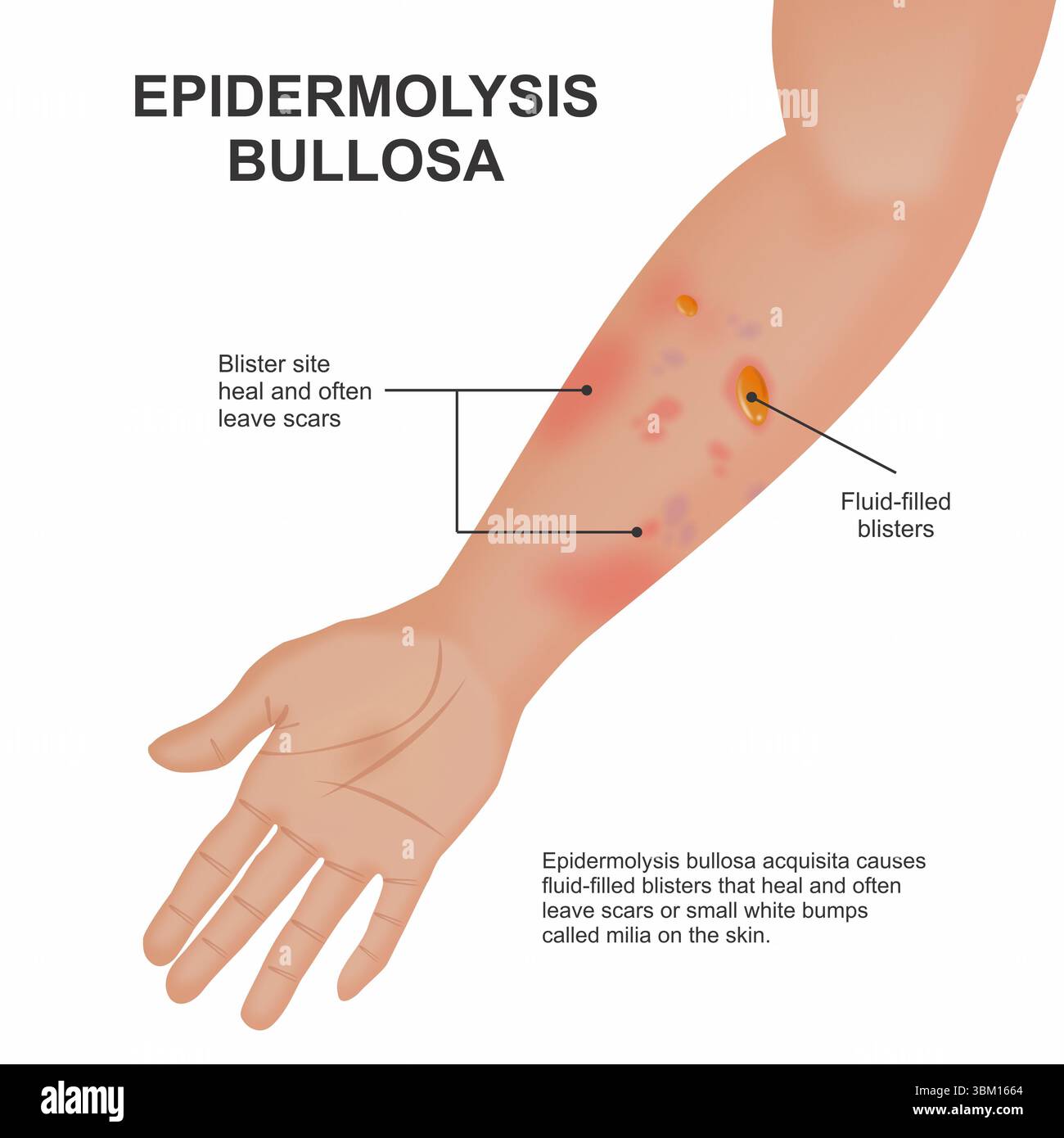 Epidermolysis bullosa hi-res stock photography and images - Alamy
