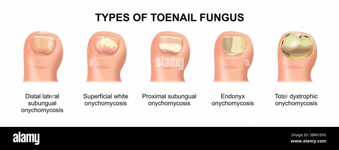 Fungal types hi-res stock photography and images - Alamy