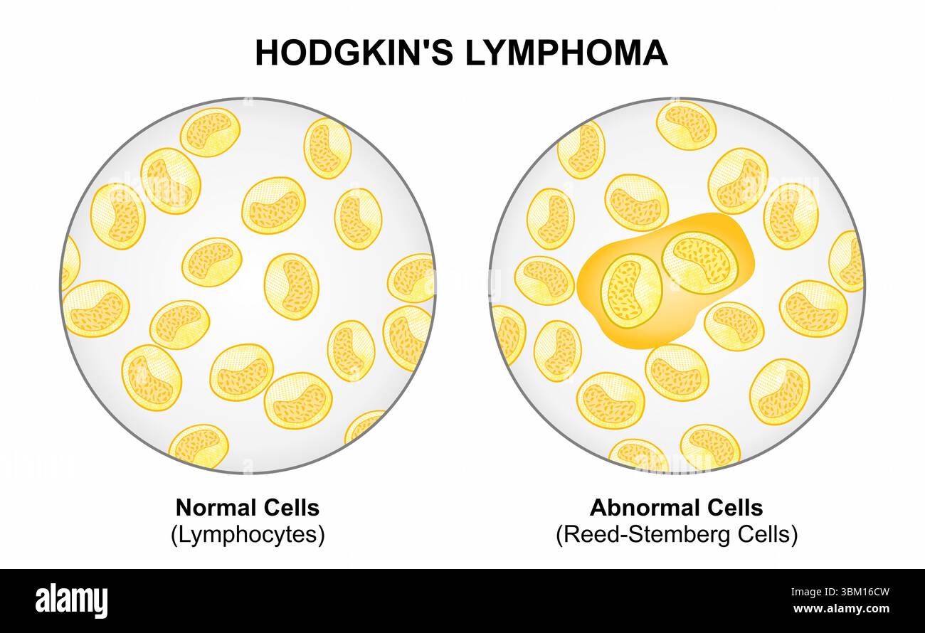 Pulmonary lymphoma hi-res stock photography and images - Alamy