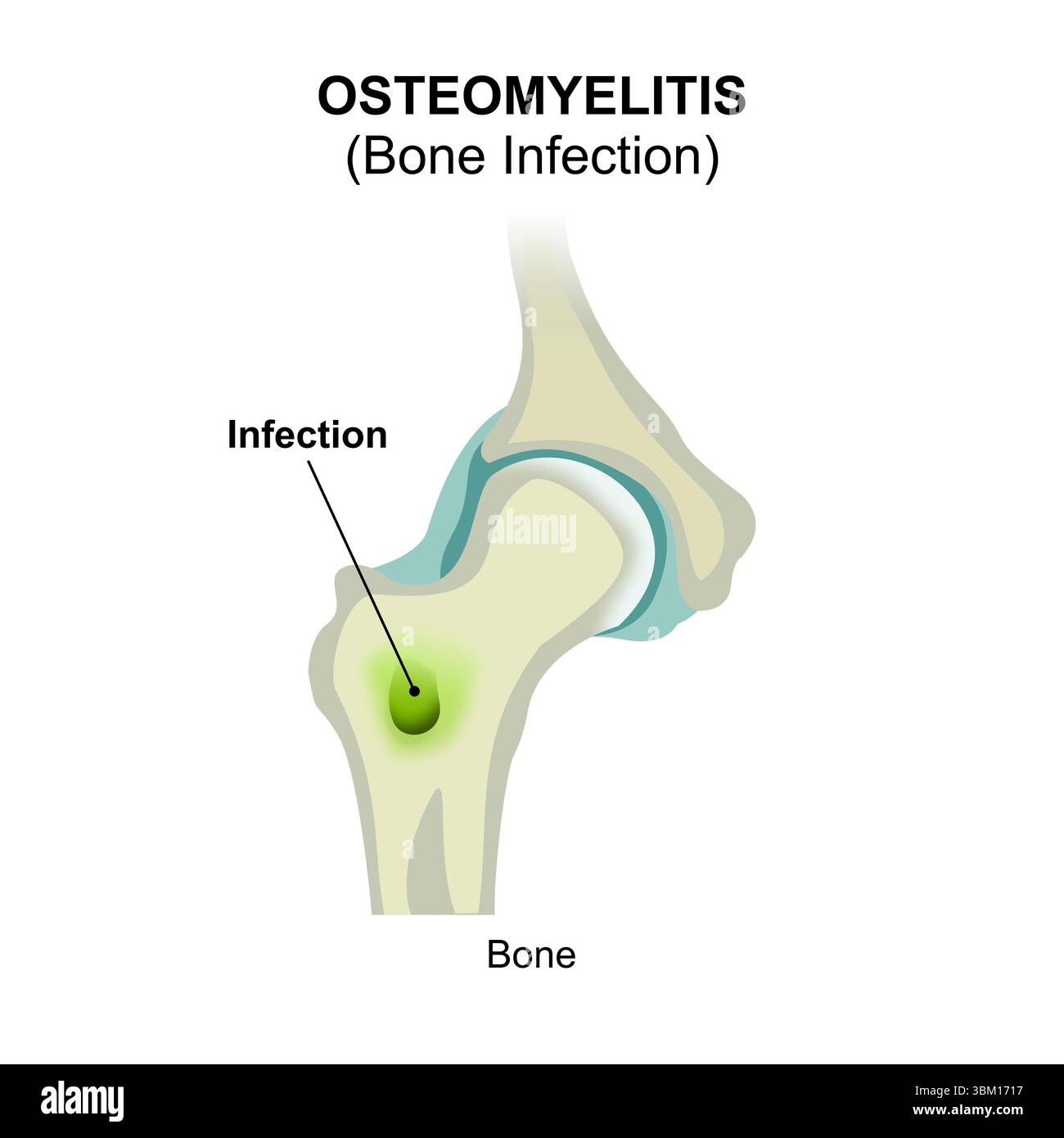 Osteomyelitis (Bone Infection Stock Photo - Alamy