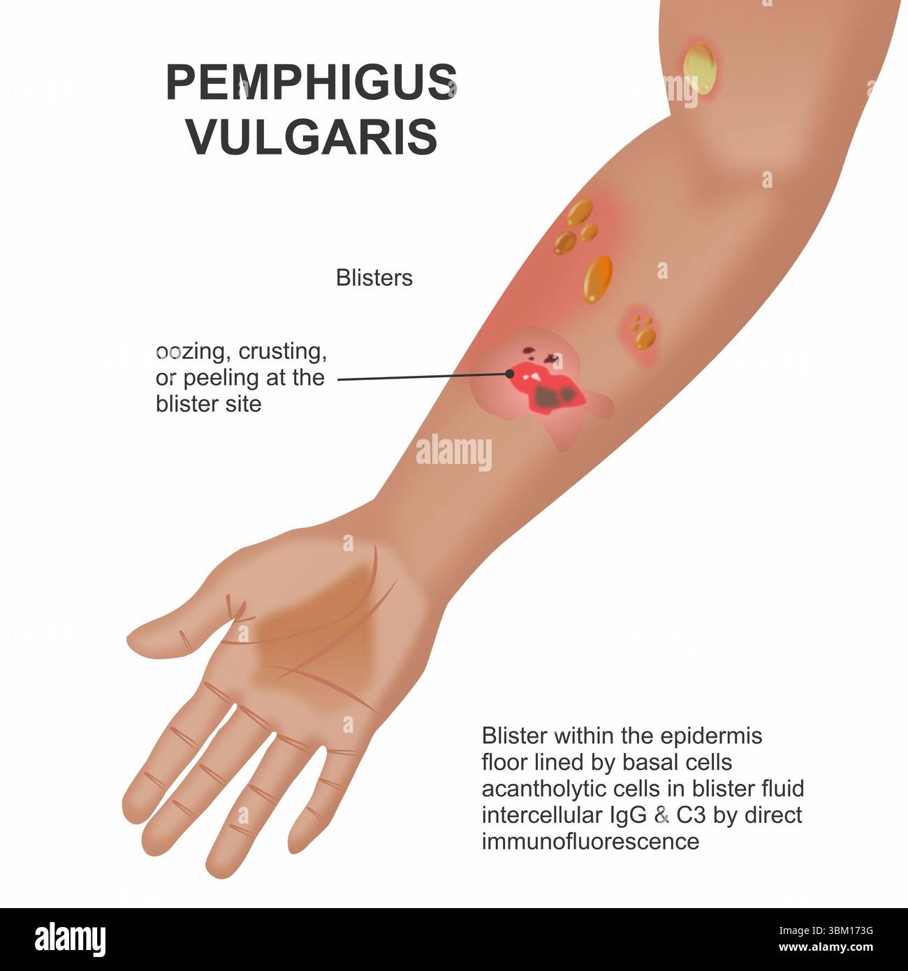 Pemphigus vulgaris lesions hi-res stock photography and images - Alamy