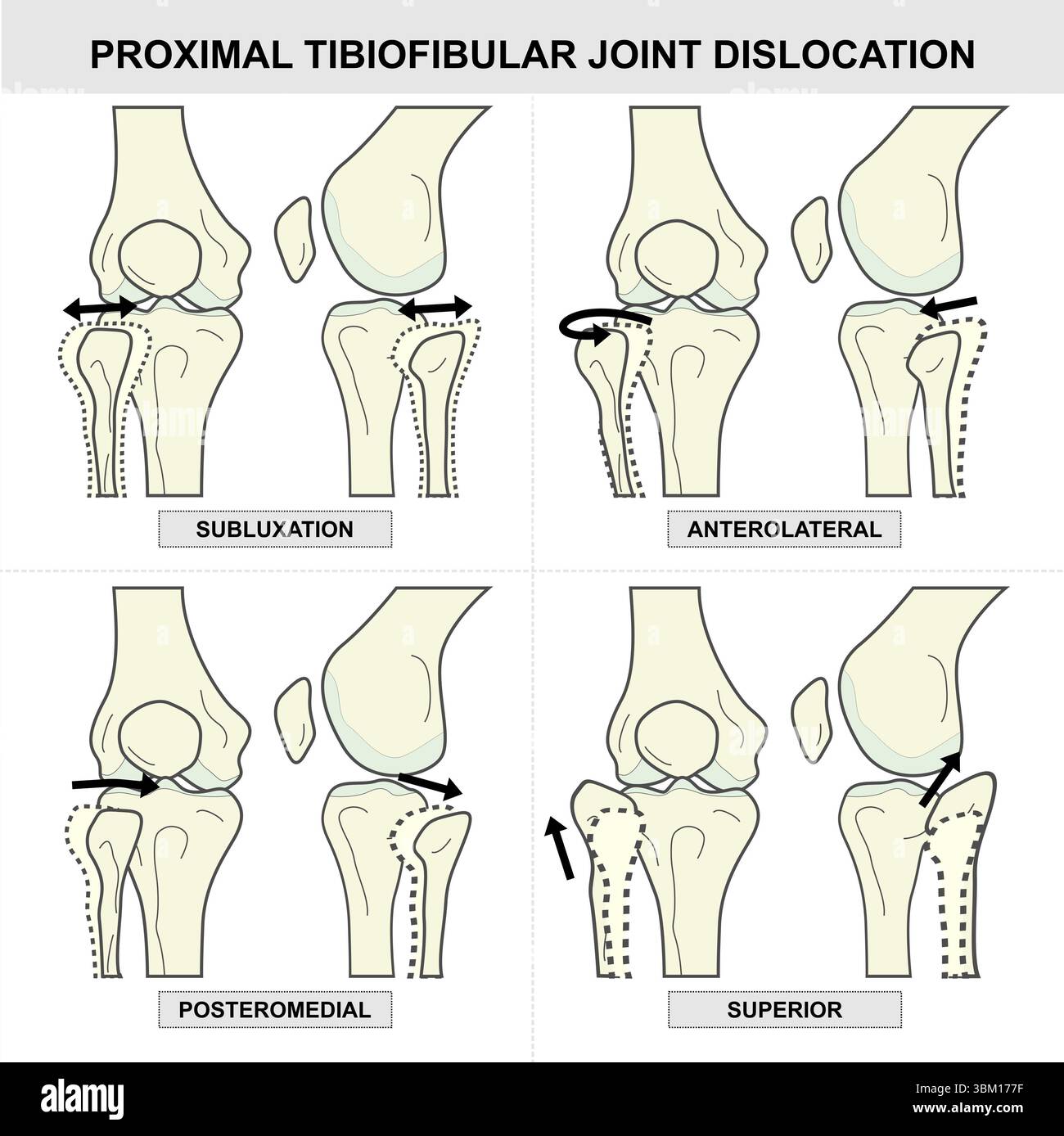 Tibia Dislocation Anterior dislocation of the knee hi-res stock photography and images ...