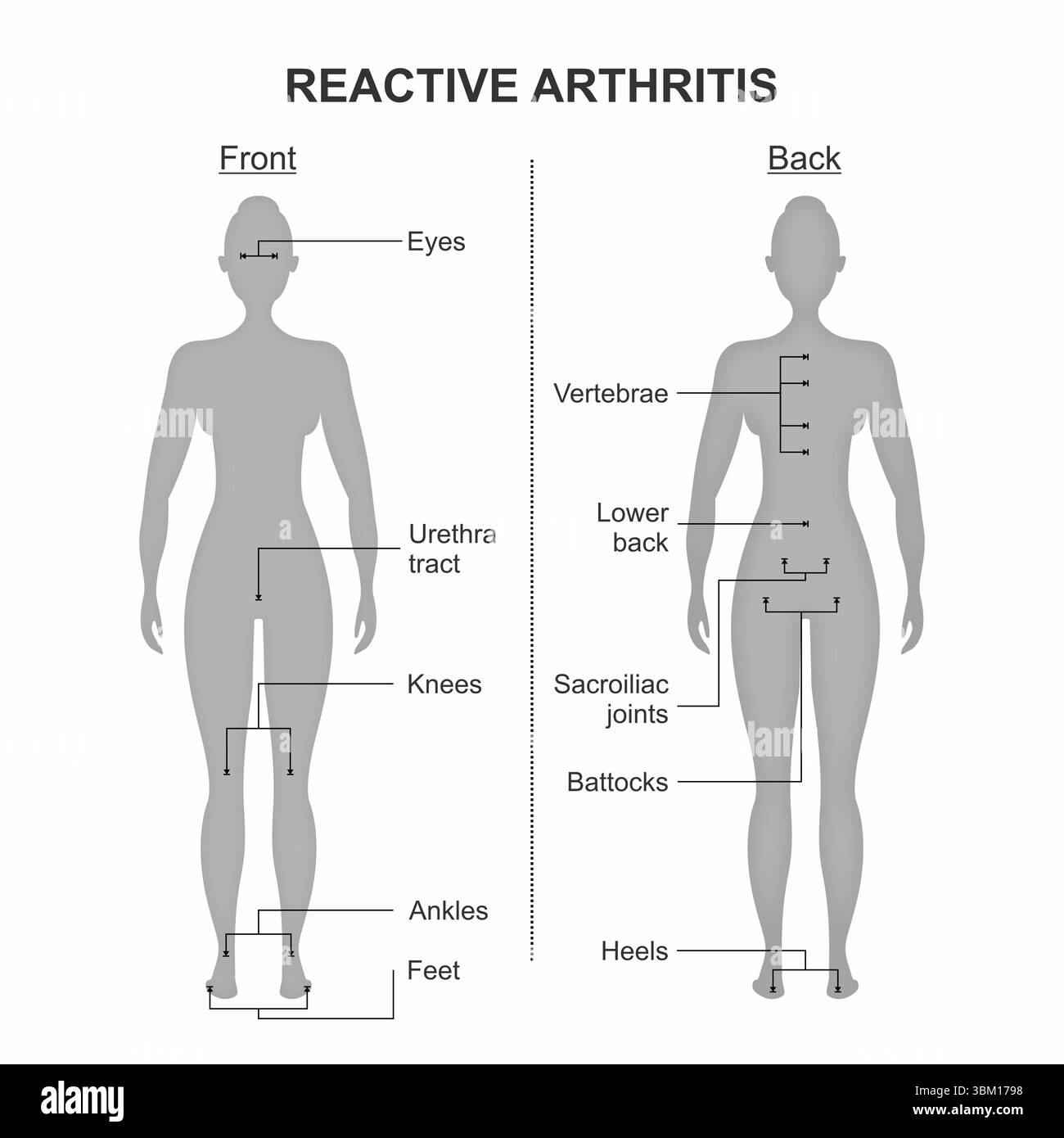 Reactive arthritis symptoms illustration Stock Photo
