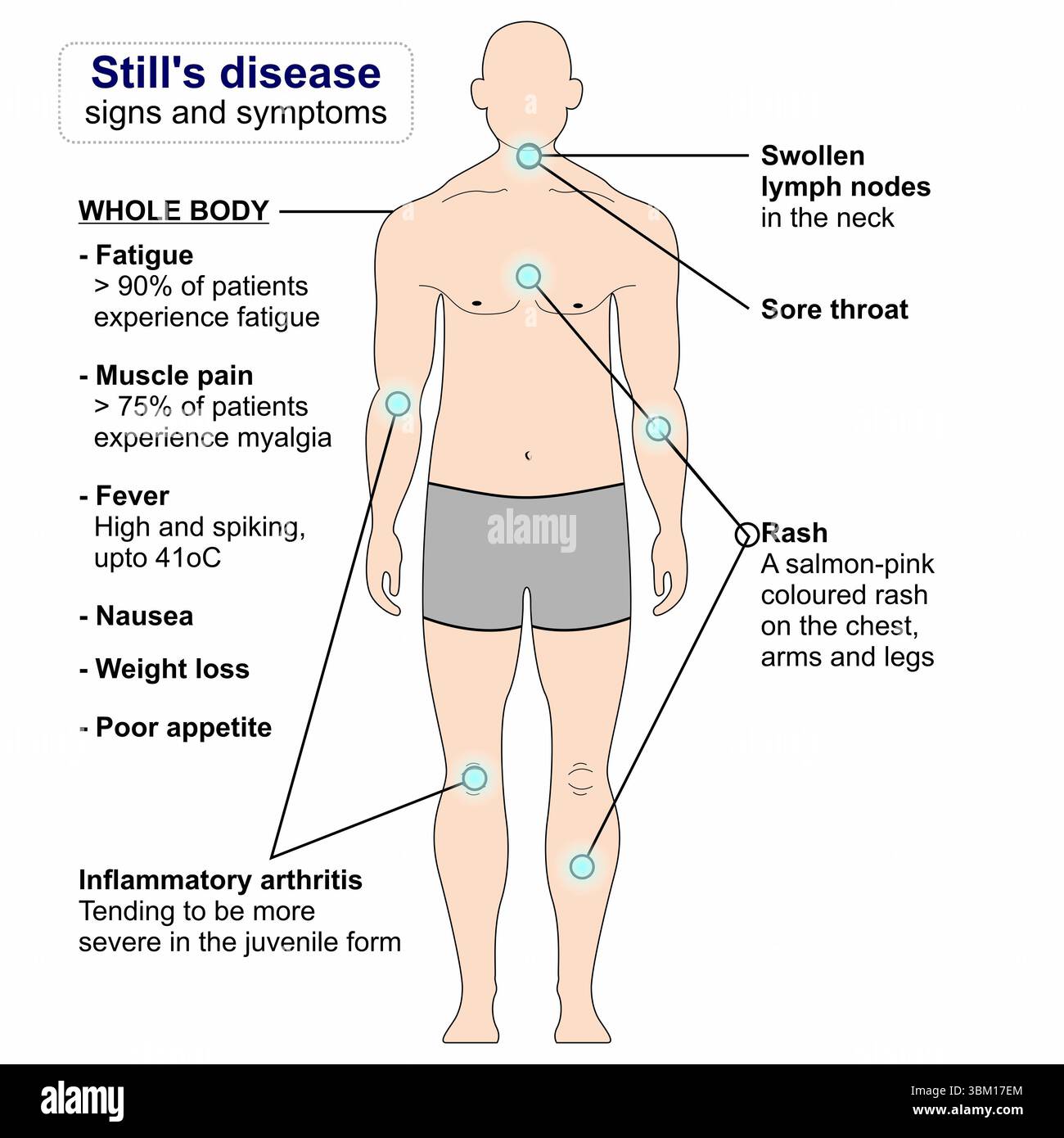 Still's disease illustration Stock Photo - Alamy