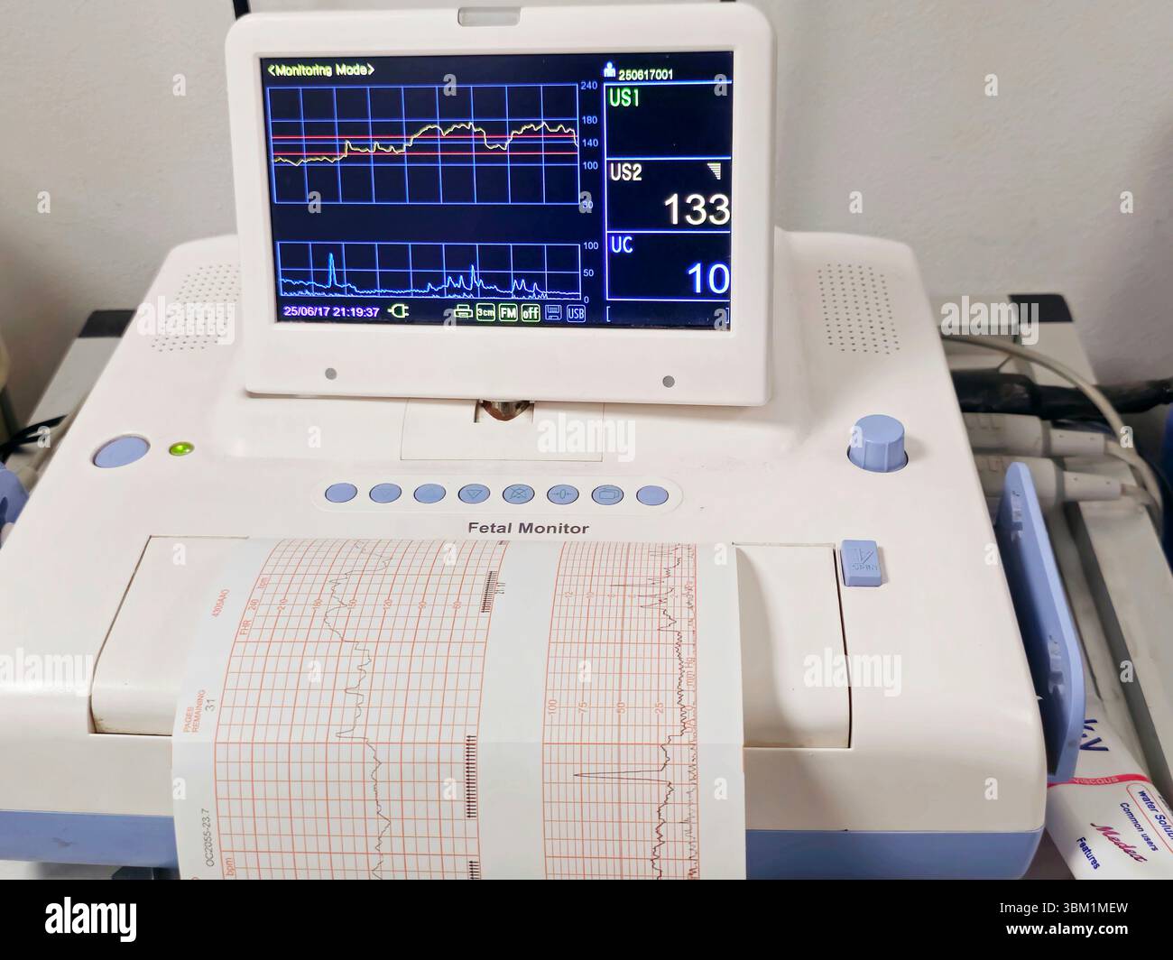 Cardiotocography device placed on mother's abdomen recording the fetal ...